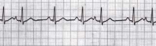 Electrocardiogram (ECG)